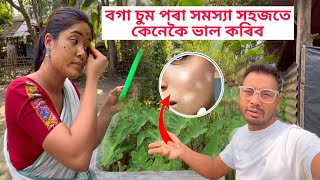 How to remove white spots on the skin ll চুম পৰা দাগ কেনেকৈ আঁতৰাব সহজে 📌 [upl. by Yrekcaz]