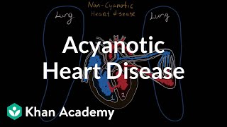 What is acyanotic heart disease  Circulatory System and Disease  NCLEXRN  Khan Academy [upl. by Neeka]