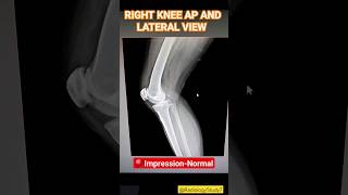 Knee AP and lateral view  Xray radiology education medical radiographers xray shorts [upl. by Kissie]