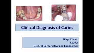 Clinical diagnosis of Dental Caries Part2 [upl. by Goebel948]