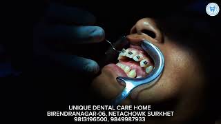 Ortho Treatment  UNIQUE DENTAL CARE HOME  BIRENDRANAGAR6 NETACHOWK SURKHET  9849987933 [upl. by Jehanna]