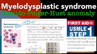 Myelodysplastic syndrome amp PseudoPelgerHuet anomaly in HindiUrdu by first aid for USMLE step 1 [upl. by Ramed]