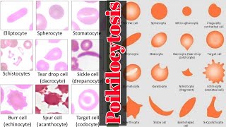 Blood Smear Examination POILKILOCYTOSIS blood smear Lecture 4 [upl. by Omer]