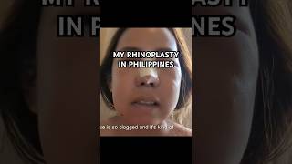 My rhinoplasty recovery in Philippines  full video on my channel [upl. by Brantley]