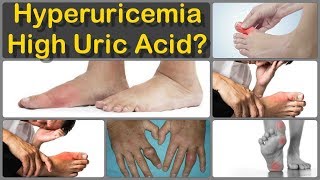 Control High Uric Acid  Signs amp Symptoms  Step by Step Guide [upl. by Miran]