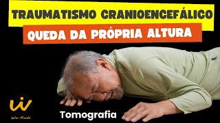 TCE TRAUMATISMO CRANIOENCEFÁLICO em Queda da Própria Altura visto na Tomografia de Crânio [upl. by Anawyt]