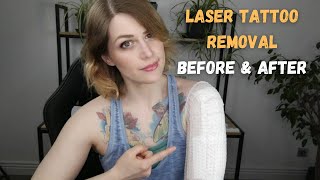 Laser Tattoo Removal Before amp After [upl. by Chapnick]