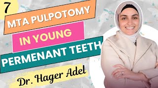 MTA pulpotomy in young permanent teeth  Dr Hager Adel [upl. by Otilia219]