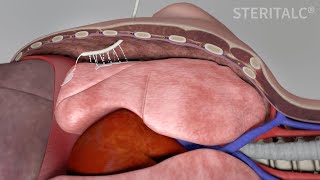 STERITALC®  poudrage vs slurry [upl. by Fishbein728]