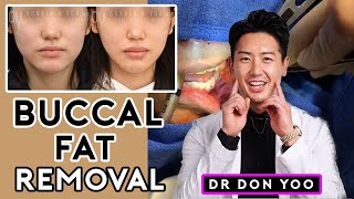 All About Buccal Fat Removal Surgery and Recovery  Dr Donald B Yoo [upl. by Eatnwahs]