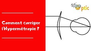 Comment corriger lHypermétropie [upl. by Lennaj808]