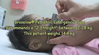 Pediatric Laryngoscope Blade Length Selection [upl. by Ahsiemat193]