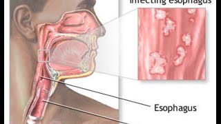 Candida Esophagitis [upl. by Delgado439]