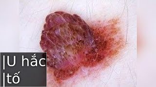 Các loại melanocytic neoplasms [upl. by Misty]