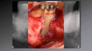 036 El uso de aumento en Endodoncia [upl. by Leahcimnaj]