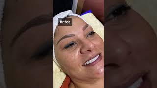 Dermaplaning  Centro de Estética Jessica Barraza [upl. by Pros]