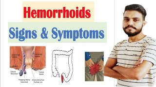 Hemorrhoids types causes  Pathophysiology treatment of piles  MrPalsaniya Sir [upl. by Neenej]