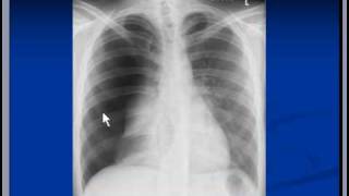 Chest xray interpretation Pneumothorax [upl. by Naej]