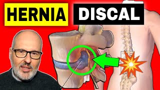 HERNIA DISCAL SÍNTOMAS CAUSAS y SOLUCIONES [upl. by Brandise858]