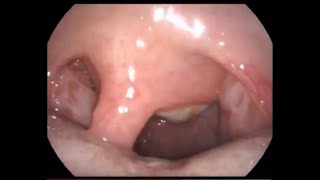 Large Antrochoanal Polyp Causing Nose Block [upl. by Latouche]