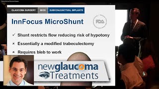 Subconjunctival Implants for Glaucoma InnFocus MicroShunt® Xen 45 Gel Stent [upl. by Retsevlis]