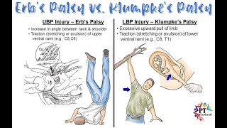 Erb Duchennes palsy and Klumpkes palsy differences Anatomically and Clinically [upl. by Hazeghi]