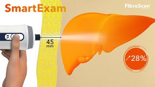 SmartExam enhances FibroScan® capabilities for improved management of fatty liver patients [upl. by Ahsyle662]