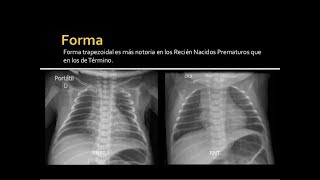 RADIOLOGIA PEDIÁTRICA TÓRAX parte 1 [upl. by Ddarb358]