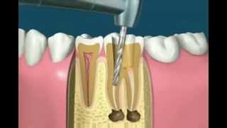 Traitement radiculaire [upl. by Redmer]