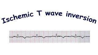 Mechanism of ischemic T wave inversion [upl. by Ientruoc350]