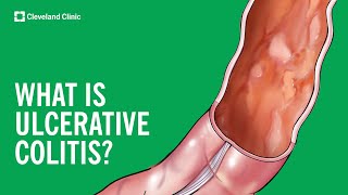 What Is Ulcerative Colitis [upl. by Ettenot]