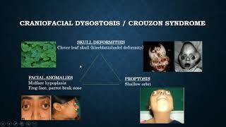 Brief discussion on Crouzon syndrome [upl. by Vallery]