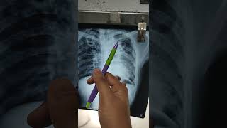 chest xray of pulmonary tuberculosis [upl. by Yrellam]