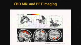 PSP Diagnosis and Treatment Options [upl. by Selokcin]