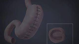 Gastric Plication Bariatric Surgery Animation 2020 Dr DavtyanBeverly Hills Glendale [upl. by Amory]