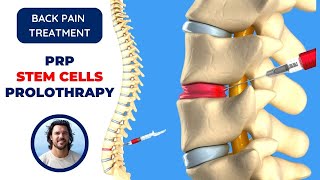 🔺 Stem Cell Therapy PRP Prolotherapy for Back Pain Relief Treatment that Works [upl. by Porche]