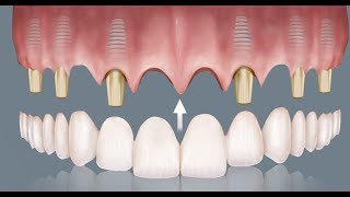 Implantes dentales ventajas e inconvenientes [upl. by Sokil]