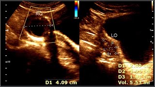 Complex Ovarian cyst  Hemorrhagic cyst [upl. by Annmarie771]