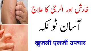 Jism ki kharish aur allergy khatam karne ka asan tarika  Skin allergy treatment at home  Khujli [upl. by Atiuqam164]