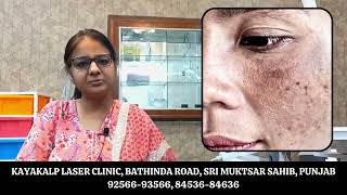 Best Laser Treatment for Melasma  Best Melasma Treatment  Pigmentation  Pico Laser  IPL [upl. by Macintosh]