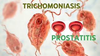 TRICHOMONIASIS ROLE IN PROSTATITIS [upl. by Annairdua]