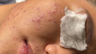 Blackheads amp Pimples Pore Removal New 2024  Acne Treatment With Bo Nguyễn Spa 027 [upl. by Asin983]