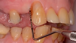 Periodontal Gum Disease Treated with Guided Tissue Regeneration Upper Canine [upl. by Ardied]