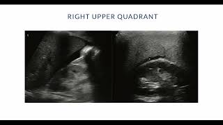 3 Basic Abdominal Ultrasound  PreExpedition Introduction to POCUS [upl. by Ardnad]