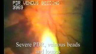 VideoDocumentation of Retinal Diseases [upl. by Wemolohtrab]