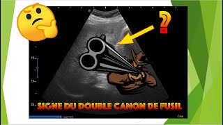 Echographie du cholédoque signe du double canon de fusil [upl. by Zenda]