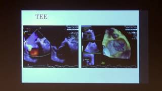 Illustrative Case Presentations 2  2017 UCLA ACHD Symposium [upl. by Ronal]