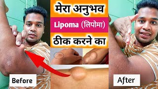 Lipoma Natural Treatment  Lipoma Kaise Thik Kare  Lipoma Treatment By Exercise [upl. by Yecies844]