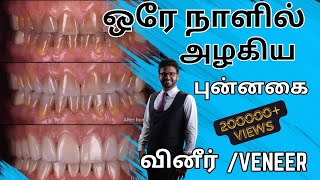 3 நாட்களில் நிரந்தர பல் சீரமைப்புடெண்டல் வினீர் 𝐃𝐞𝐧𝐭𝐚𝐥 𝐕𝐞𝐧𝐞𝐞𝐫 𝐢𝐧 𝐓𝐚𝐦𝐢𝐥 𝐈𝐦𝐦𝐞𝐝𝐢𝐚𝐭𝐞 𝐬𝐦𝐢𝐥𝐞 𝐦𝐚𝐤𝐞𝐨𝐯𝐞𝐫 [upl. by Sitnalta]