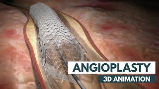 Angioplasty  3D Animation  Real Footage [upl. by Lebaron160]